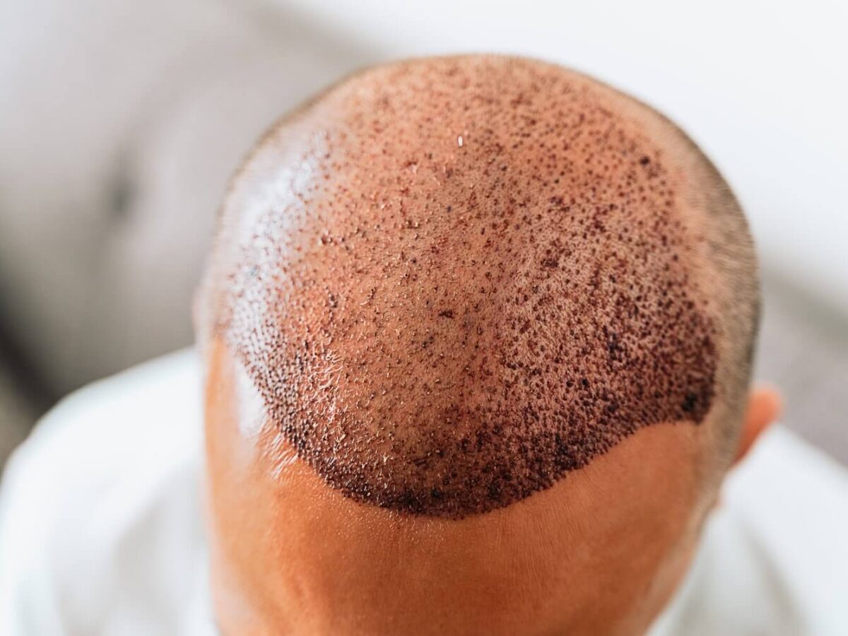 A Barber’s Guide to Haircuts After a Hair Transplant: Professional Advice from Swagger & Jacks - Swagger & Jacks Ltd