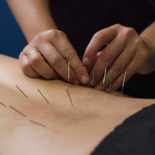 The Benefits of Dry Needling in Sports Massage - Swagger & Jacks Ltd